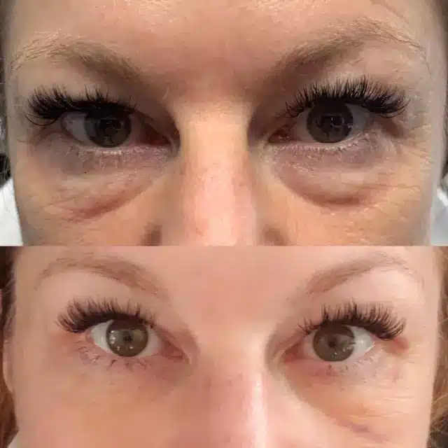 RF treatment to improve under eye bags